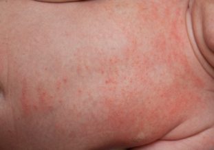 Сыпь при глистах у грудничка