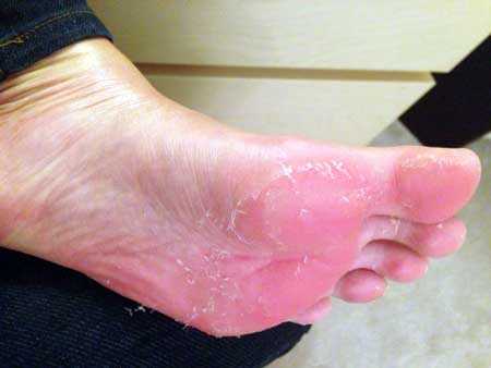 Почему слезает кожа на ступнях? По каким причинам слезает кожа на ногах?