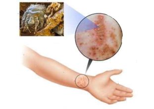 Сыпь при паразитах