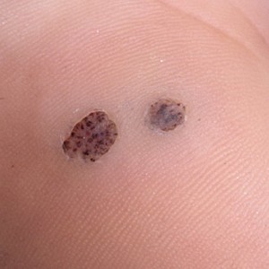 Подошвенные бородавки Бородавки на ногах: причины появления и методы лечения