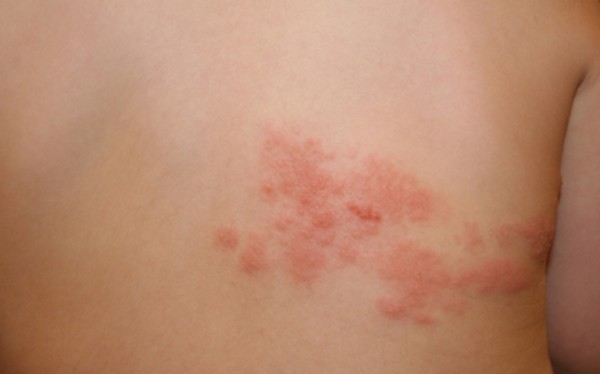 Признаки опоясывающего лишая Как определить опоясывающий лишай