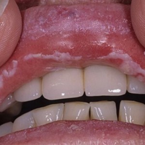 Лечение кандидоза во рту Молочница во рту: симптомы и лечение