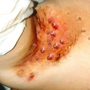 Признаки гидраденита Что такое гидраденит: фото, симптомы и лечение болезни