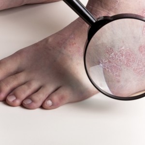 Псориаз Лечение ладонно-подошвенного псориаза. отзывы