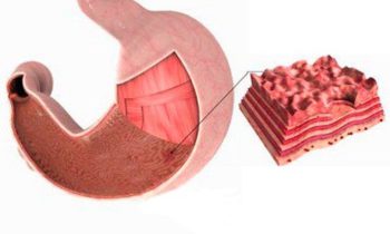 Эрозия желудка