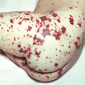 Менингококковая инфекция у детей У ребёнка по всему телу сыпь красного цвета