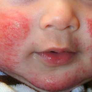 Атопический дерматит у детей до года фото Лечение атопического дерматита