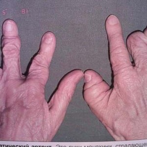 Запущеная форма псориатической артропатии Псориатическая артропатия: описание заболевания и лечение