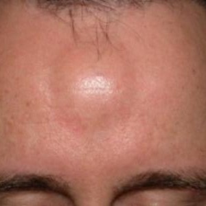 Липома на лбу Жировики на лице: причины возникновения