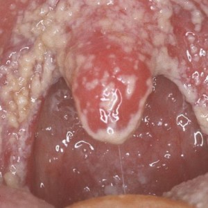 Кандидоз ротовой полости Молочница во рту: симптомы и лечение