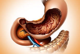 Чеснок с молоком практически не раздражает слизистую стенку желудка