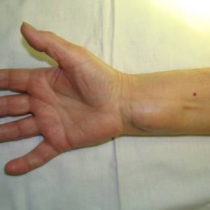 Как удалить липому в домашних условиях Липома: лечение в домашних условиях