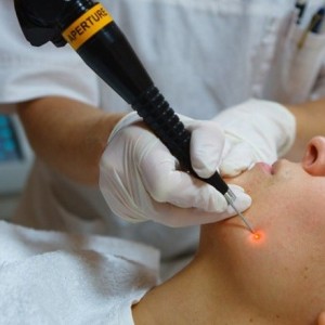 Удаление бородавок Чем лучше удалять бородавки: азотом или лазером?