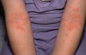 Фото: сыпь при описторхозе