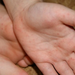 Красные мелкие прыщики на руках причины появления От чего появляется сыпь на руке в виде маленьких прыщей?