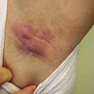 Симптомы гидраденита Что такое гидраденит: фото, симптомы и лечение болезни