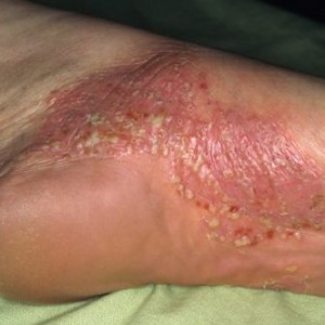 Псориаз стоп Лечение ладонно-подошвенного псориаза. отзывы