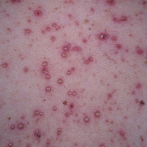 Сыпь при ветрянке у взрослых Повторная ветрянка у взрослого: возможно ли?