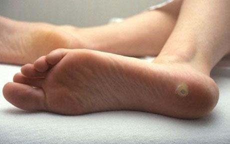 Бородавка на пятке Бородавка у ребенка на ногах: причины появления, лечение