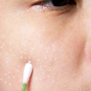 Лечение подкожных прыщей Подкожные проблемы и как с ними бороться?