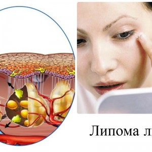 Как лечить липому в домашних условиях Липома: лечение в домашних условиях