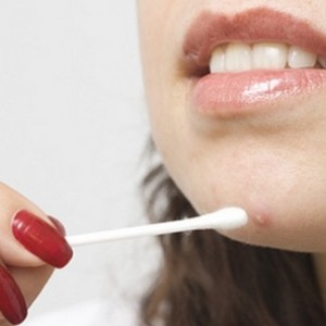 Обработка прыщей перекисью Как использовать перекись водорода от прыщей на лице?