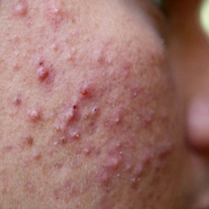 Пиодермия на лице Пиодермия: признаки, виды заболевания и методы лечения