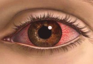 Хламидийный конъюктивит