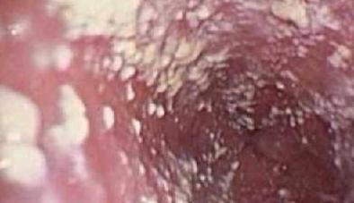 Молочница на слизистой у женщин Как может выглядеть молочница у женщин?