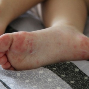 Атопическая экзема ступней Появление посттравматической экземы на пятках и стопе