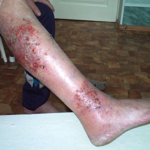 Посттравматическая экзема Появление посттравматической экземы на пятках и стопе