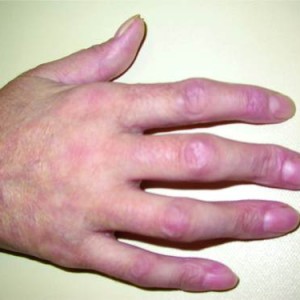 Псориатическая артропатия кистей Псориатическая артропатия: описание заболевания и лечение