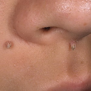 ВПЧ на лице Чем лучше удалять бородавки: азотом или лазером?