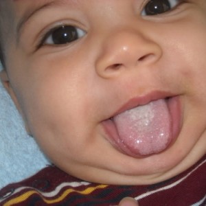 Молочница во рту у младенцев Молочница во рту: симптомы и лечение