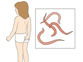 Зуд и жжение в анальной области - первый признак энтеробиоза