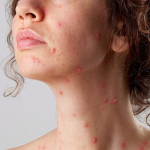 Ветрянка у взрослых Повторная ветрянка у взрослого: возможно ли?