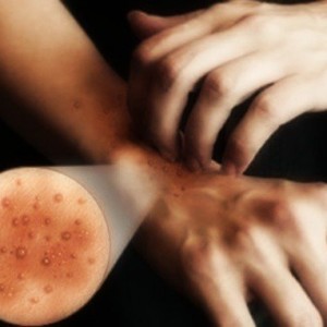 Что такое нейродермит Эффективное лечение нейродермита