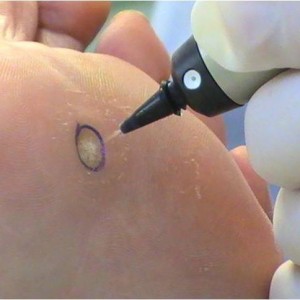 Удаление бородавки Бородавка у ребенка на ногах: причины появления, лечение