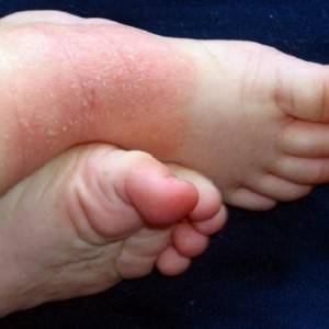 Как лечить нейродермит Эффективное лечение нейродермита