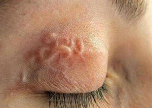 Глисты в глазу