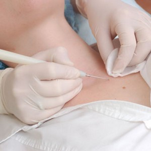 Папиллом на шее причины Причины возникновения папиллом на шее