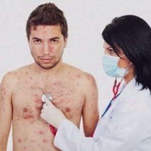 Диагностика ветрянки у взрослых Симптомы и лечение ветрянки у взрослого человека