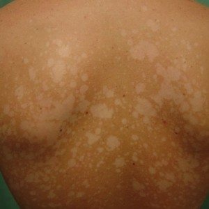 Солнечный лищай Клинические особенности солнечного(пляжного) лишая