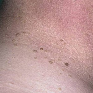 Причина появления папиллом на шее Причины возникновения папиллом на шее