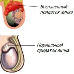 Воспаление придатка яичка